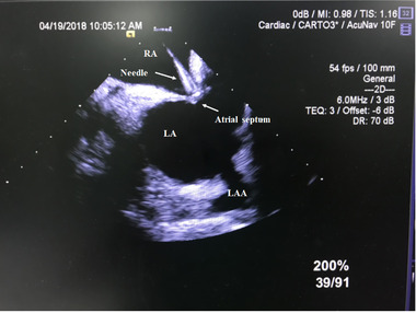 2019 Chinese expert consensus statement on left atrial appendage closure in patients with atrial fibrillation.