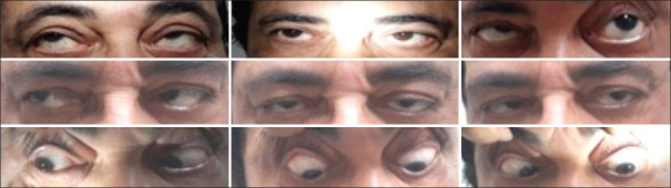 Abduction Deficit Mimicking Sixth Nerve Palsy due to Metastasis in Systemic Malignancy: Rare Case Report.