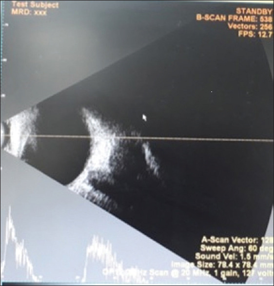 Abduction Deficit Mimicking Sixth Nerve Palsy due to Metastasis in Systemic Malignancy: Rare Case Report.