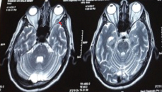 Abduction Deficit Mimicking Sixth Nerve Palsy due to Metastasis in Systemic Malignancy: Rare Case Report.