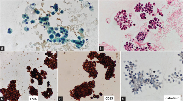 Application of the Indian Academy of Cytologists Recommendations for Reporting Serous Fluid Cytopathology in Routine Reporting of Ascitic Fluid Specimen and Assessment of the Risk of Malignancy.