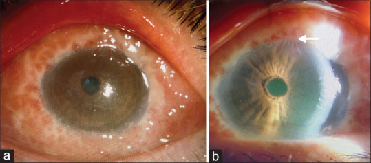 Ocular Sporotrichosis with Limbal Stem Cell Deficiency: An Impostor with Blinding Sequelae.