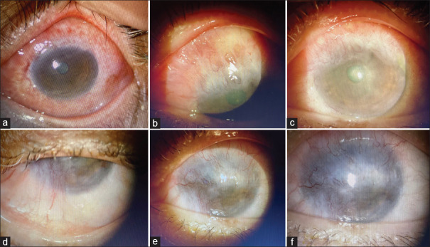 Ocular Sporotrichosis with Limbal Stem Cell Deficiency: An Impostor with Blinding Sequelae.