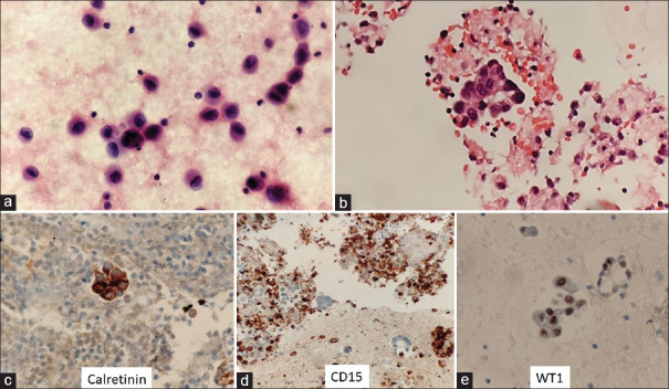 Application of the Indian Academy of Cytologists Recommendations for Reporting Serous Fluid Cytopathology in Routine Reporting of Ascitic Fluid Specimen and Assessment of the Risk of Malignancy.