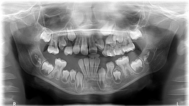 Use of the Demirjian method to estimate dental age in panoramic radiographs of patients treated at the Buenos Aires University School of Dentistry.