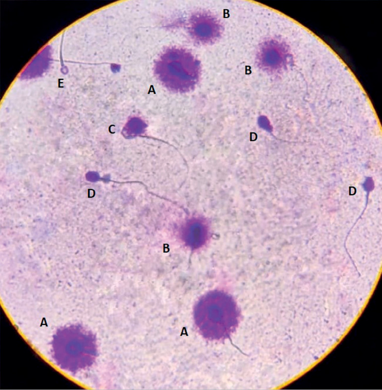 Association between terbinafine hydrochloride and sperm DNA fragmentation - case report.
