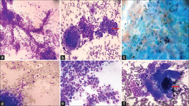 Xanthogranulomatous Cholecystitis with Coexisting Carcinoma- A Diagnostic Pitfall in Cytology.