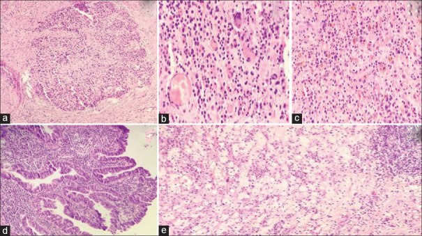 Xanthogranulomatous Cholecystitis with Coexisting Carcinoma- A Diagnostic Pitfall in Cytology.