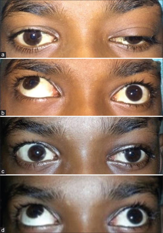 Outcomes of Posterior Approach Surgery in Various Types and Grades of Upper Eyelid Blepharoptosis in Indian Eyes.