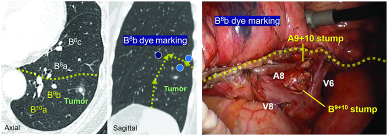 Efficacy of the Segment-Counting Method in Predicting Lung Function and Volume Following Stapler-Based Thoracoscopic Segmentectomy.