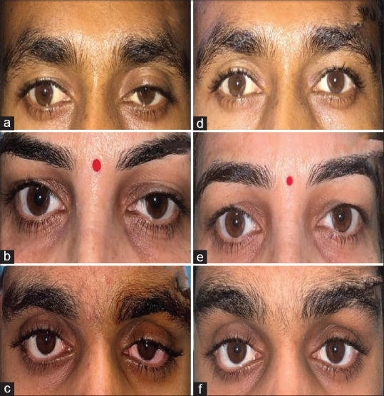 Outcomes of Posterior Approach Surgery in Various Types and Grades of Upper Eyelid Blepharoptosis in Indian Eyes.