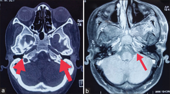 Approach to new-onset facial nerve palsy in a critically ill patient: A case report.