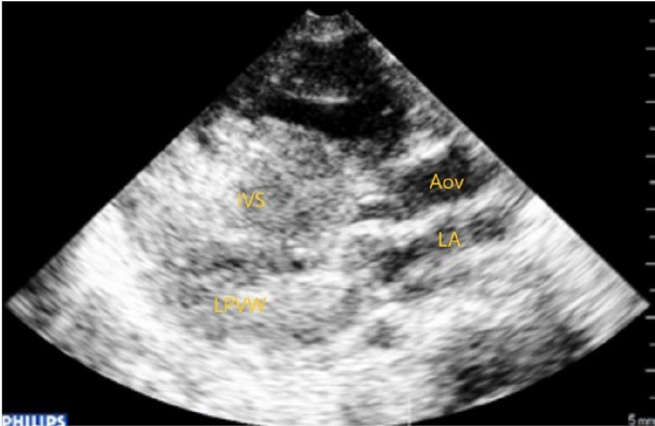 RAF-1 Mutation Associated with a Risk for Ventricular Arrhythmias in a Child with Noonan Syndrome and Cardiovascular Pathology.