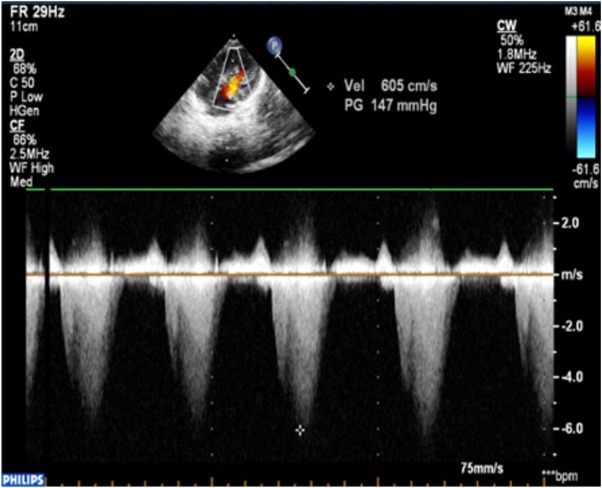 RAF-1 Mutation Associated with a Risk for Ventricular Arrhythmias in a Child with Noonan Syndrome and Cardiovascular Pathology.