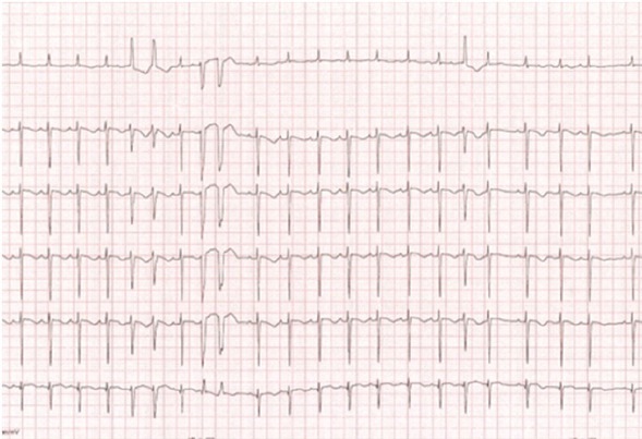 RAF-1 Mutation Associated with a Risk for Ventricular Arrhythmias in a Child with Noonan Syndrome and Cardiovascular Pathology.