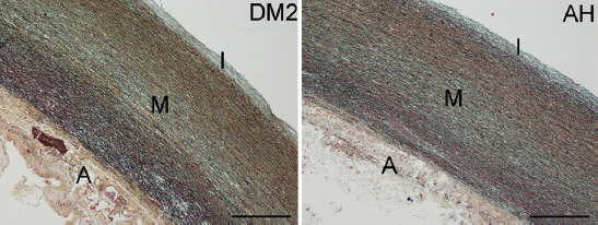 Inflammatory cells in the ascending aortic aneurysm in patients with type 2 diabetes versus patients with hypertension.