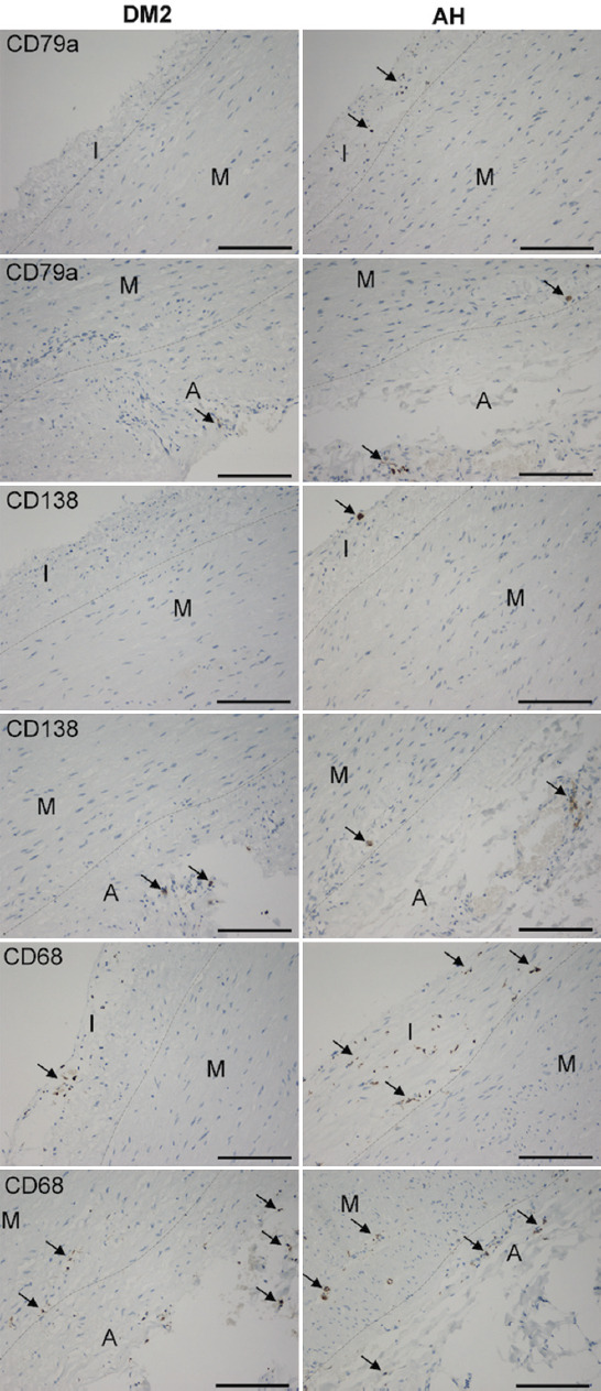 Inflammatory cells in the ascending aortic aneurysm in patients with type 2 diabetes versus patients with hypertension.