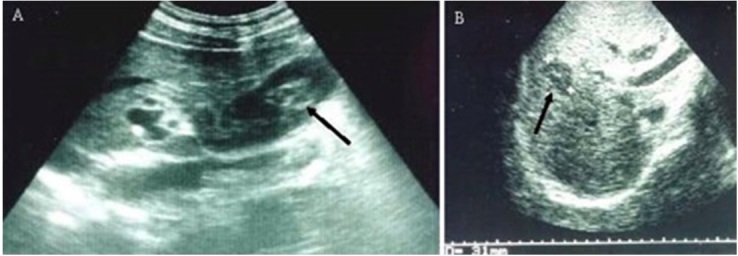 Hemobilia Caused by Arterioportal Fistula Following Percutaneous Liver Biopsy Complicated by Acute Cholecystitis and Review of the Literature.