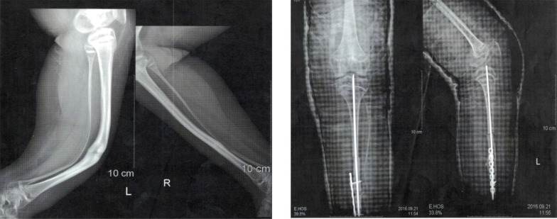 Clinical Response to Treatment with Teriparatide in an Adolescent with Osteoporosis-Pseudoglioma Syndrome (OPPG): A Case Report.