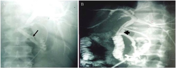 Hemobilia Caused by Arterioportal Fistula Following Percutaneous Liver Biopsy Complicated by Acute Cholecystitis and Review of the Literature.