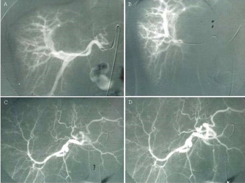 Hemobilia Caused by Arterioportal Fistula Following Percutaneous Liver Biopsy Complicated by Acute Cholecystitis and Review of the Literature.