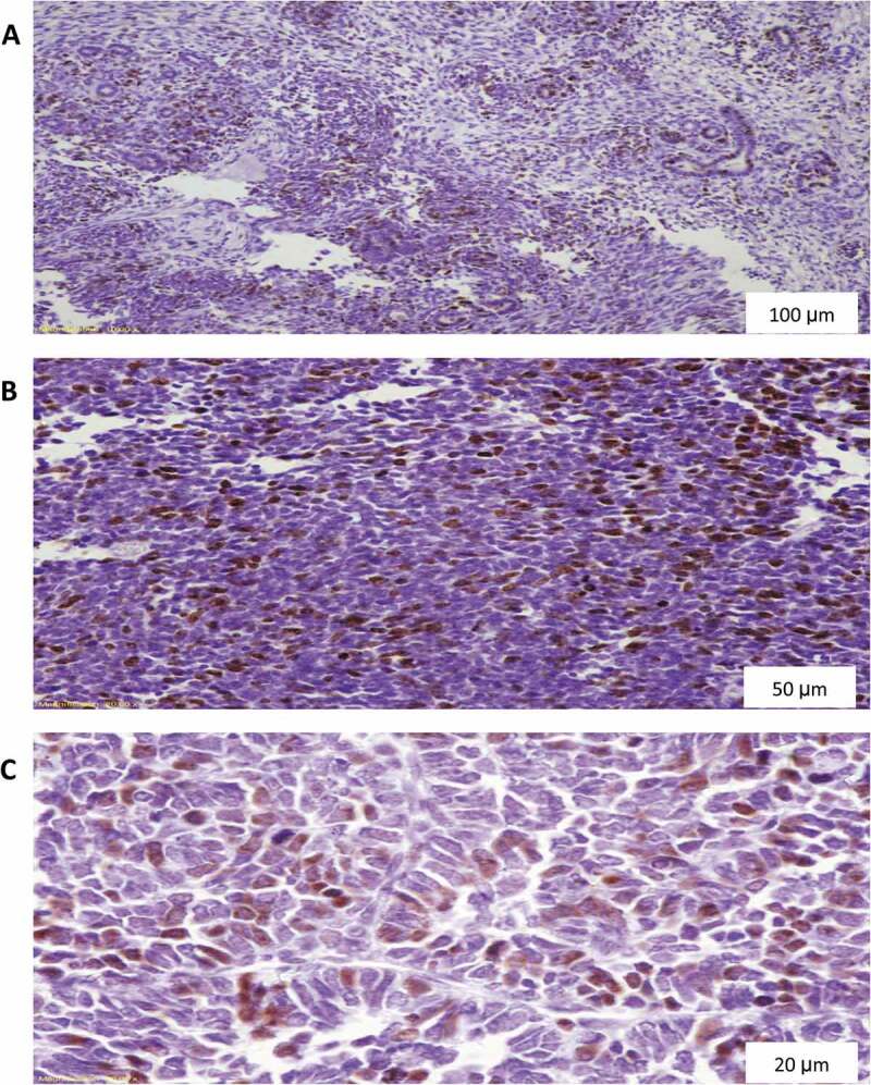 Does immunohistochemical staining of P53, Ki 67 and cyclin A accurately predict Wilms tumor recurrence and survival?