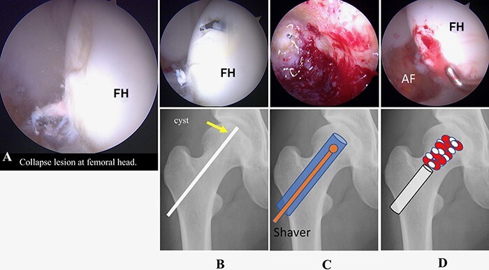 Hip arthroscopic management for treating a rhythmic gymnast with a large bone cyst at the femoral head in the setting of hip dysplasia-a case report.