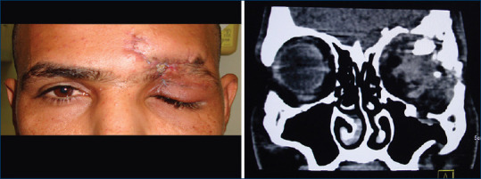 Terror-Related Ocular Trauma in Patients Presenting to a Tertiary Eye Center in the Middle East.