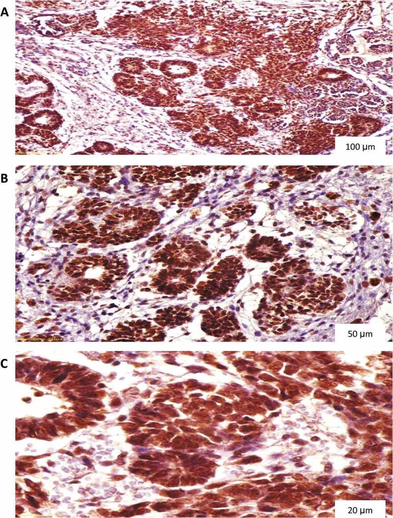 Does immunohistochemical staining of P53, Ki 67 and cyclin A accurately predict Wilms tumor recurrence and survival?