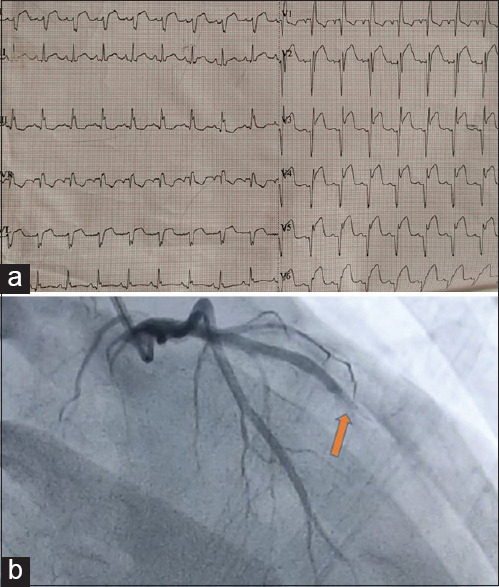 Myocardial Infarction after ChAdOx1 nCoV-19 in a Young Male.