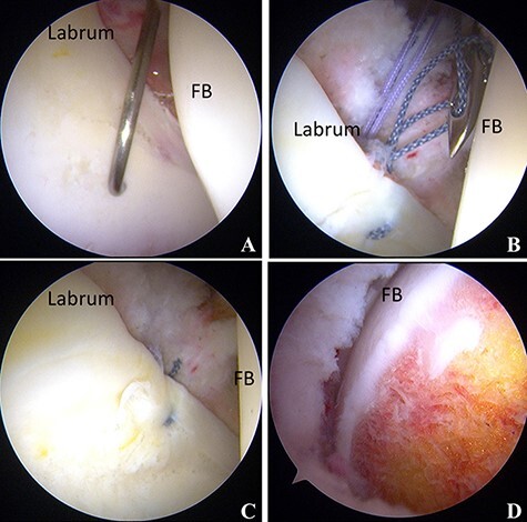 Hip arthroscopic management for treating a rhythmic gymnast with a large bone cyst at the femoral head in the setting of hip dysplasia-a case report.