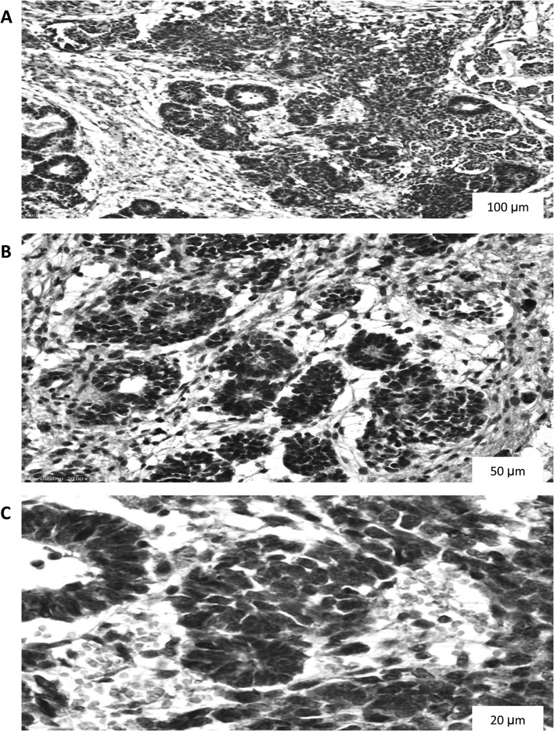 Does immunohistochemical staining of P53, Ki 67 and cyclin A accurately predict Wilms tumor recurrence and survival?