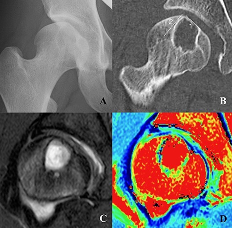 Hip arthroscopic management for treating a rhythmic gymnast with a large bone cyst at the femoral head in the setting of hip dysplasia-a case report.