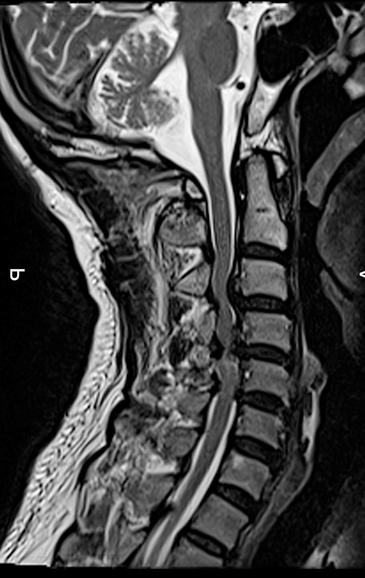 Knee Pain Following Total Knee Arthroplasty Secondary to Cervical Spondylotic Myelopathy.