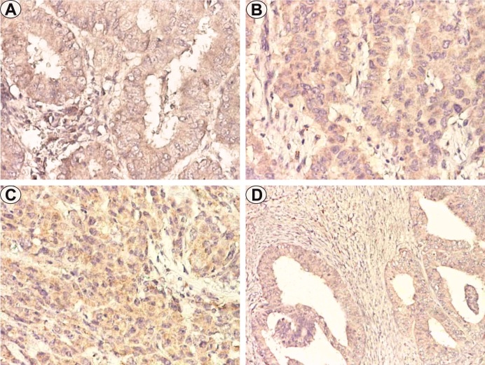 VEGF Immunoexpression in Endometrioid Endometrial Carcinomas.