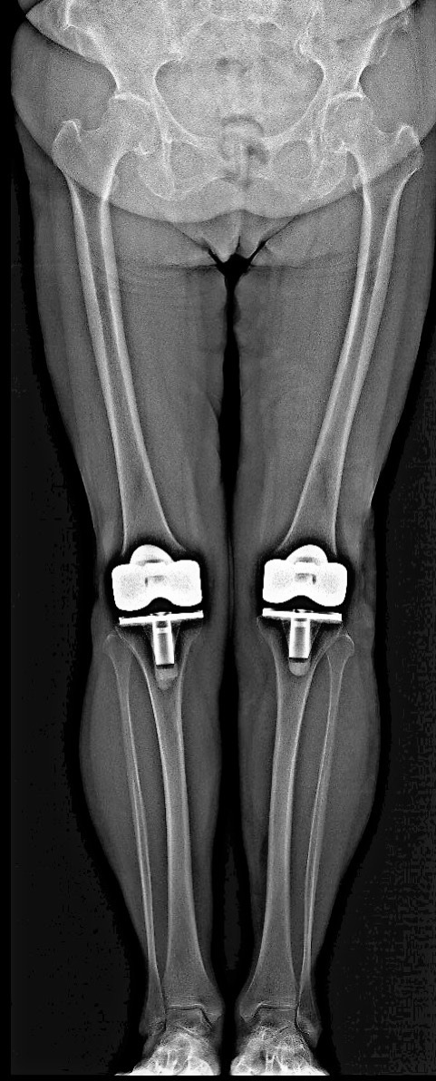 Knee Pain Following Total Knee Arthroplasty Secondary to Cervical Spondylotic Myelopathy.