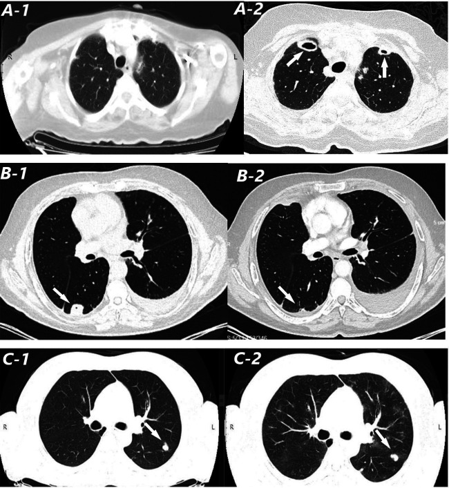 Treatment with biologic DMARDs may not adversely affect lung nodules in rheumatoid arthritis patients.