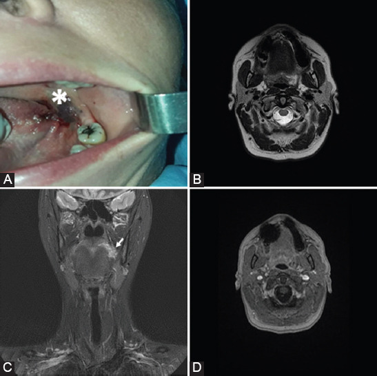 Role of dynamic contrast enhanced magnetic resonance imaging in the diagnosis and management of vascular lesions of the head and neck.