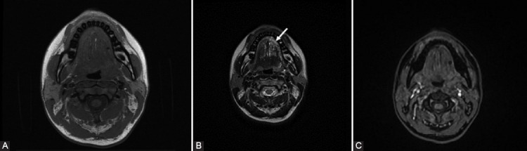 Role of dynamic contrast enhanced magnetic resonance imaging in the diagnosis and management of vascular lesions of the head and neck.