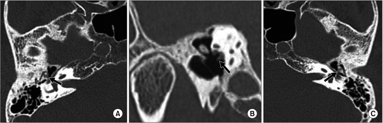 Idiopathic Inflammatory Arthritis in the Auditory Canal in a Patient With Hearing Impairment: A Case Report and Literature Review.