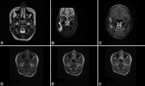 Role of dynamic contrast enhanced magnetic resonance imaging in the diagnosis and management of vascular lesions of the head and neck.