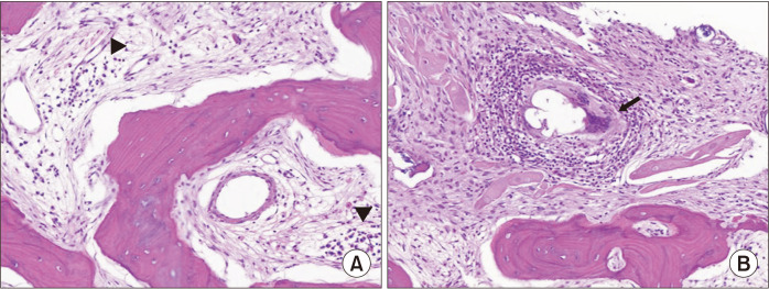 Idiopathic Inflammatory Arthritis in the Auditory Canal in a Patient With Hearing Impairment: A Case Report and Literature Review.