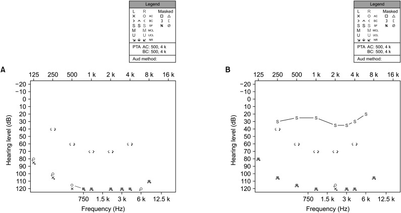 Idiopathic Inflammatory Arthritis in the Auditory Canal in a Patient With Hearing Impairment: A Case Report and Literature Review.