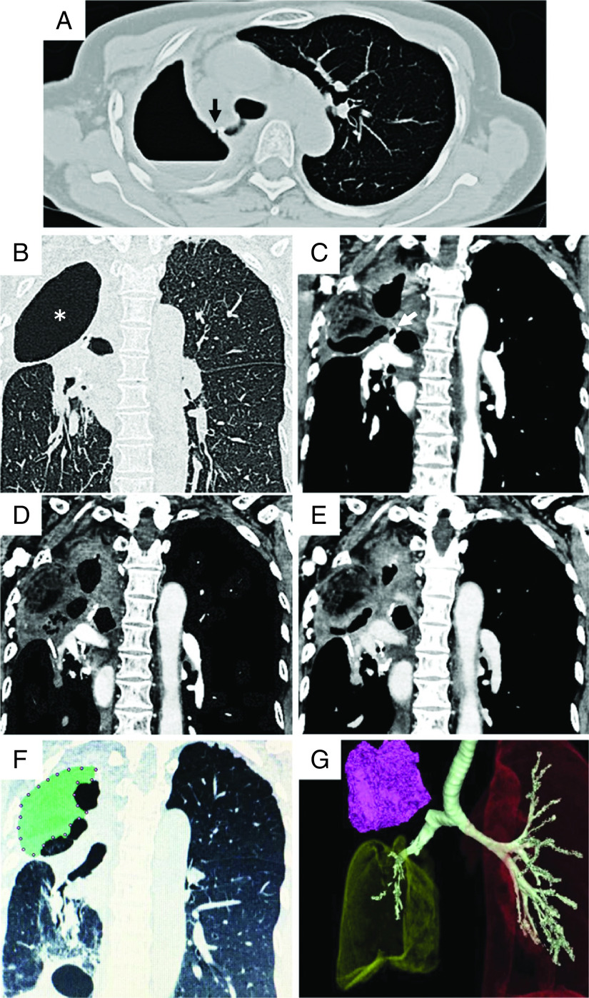 The Association of Vacuum-Assisted Closure Therapy with Dynamic Volume Change of a Muscle Flap Transposed in an Empyema Cavity for Chronic Empyema: A Case Report.