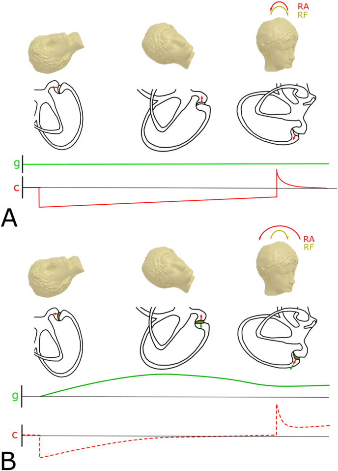 “Sitting-up vertigo as an expression of posterior semicircular canal heavy cupula and posterior semicircular canal short arm canalolithiasis”