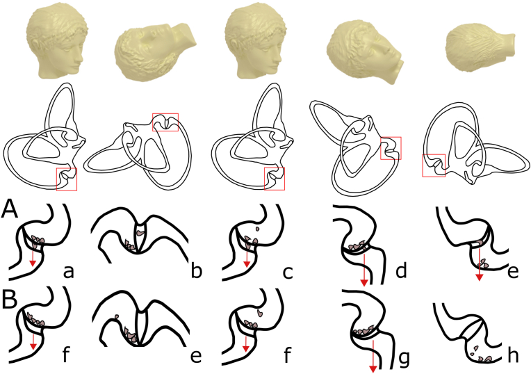 “Sitting-up vertigo as an expression of posterior semicircular canal heavy cupula and posterior semicircular canal short arm canalolithiasis”