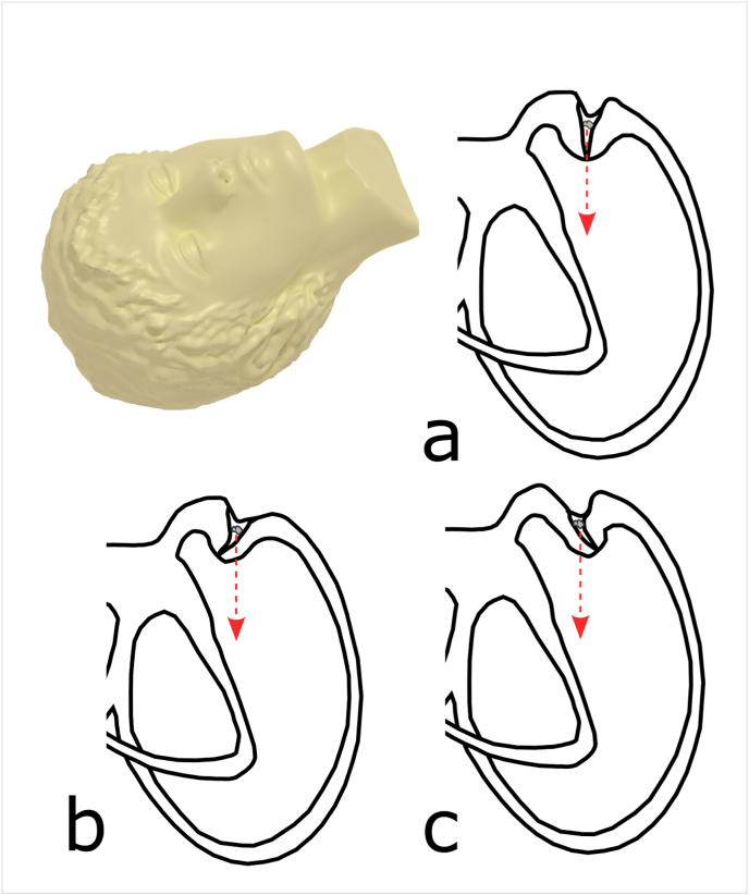 “Sitting-up vertigo as an expression of posterior semicircular canal heavy cupula and posterior semicircular canal short arm canalolithiasis”