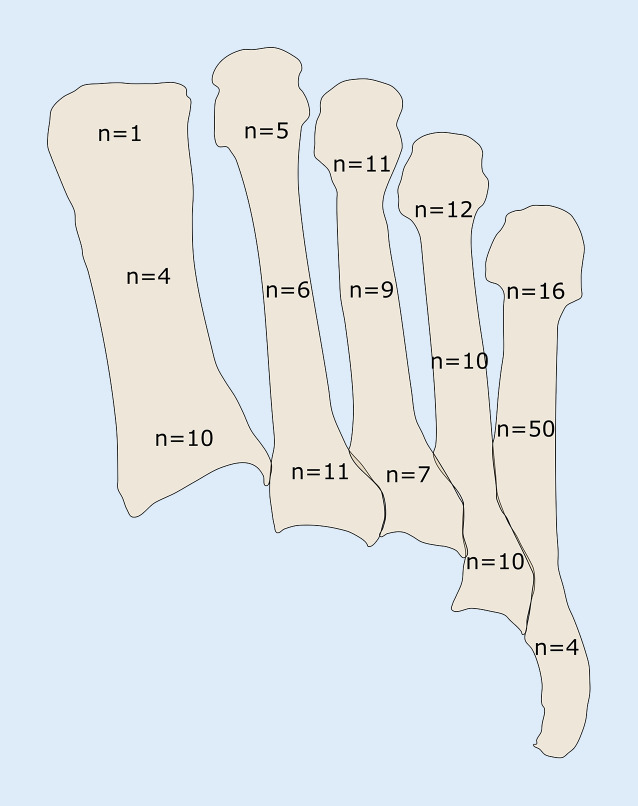 [Functional outcome of 111 metatarsal fractures following conservative in comparison to operative treatment].