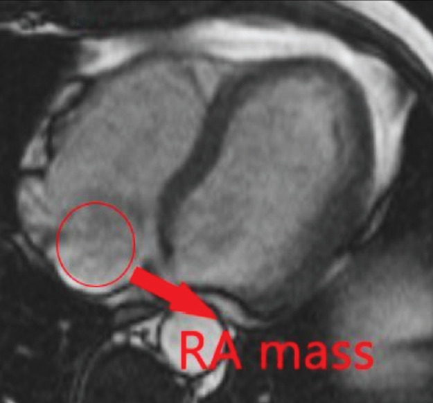 Huge Chiari Network in the Right Atrium Diagnosed as Thrombosis - Case Report and a Brief Review.