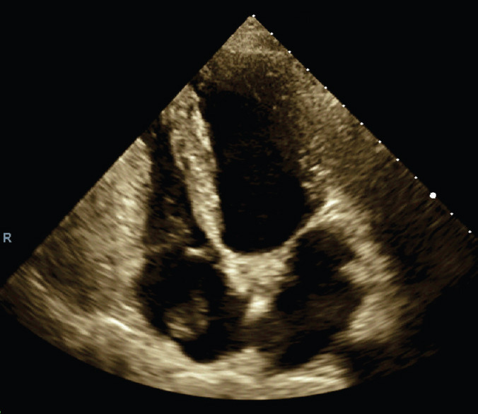 Huge Chiari Network in the Right Atrium Diagnosed as Thrombosis - Case Report and a Brief Review.